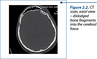 Figure 2.2. CT scan, axial view – dislodged bone frag­ments into the cerebral fossa