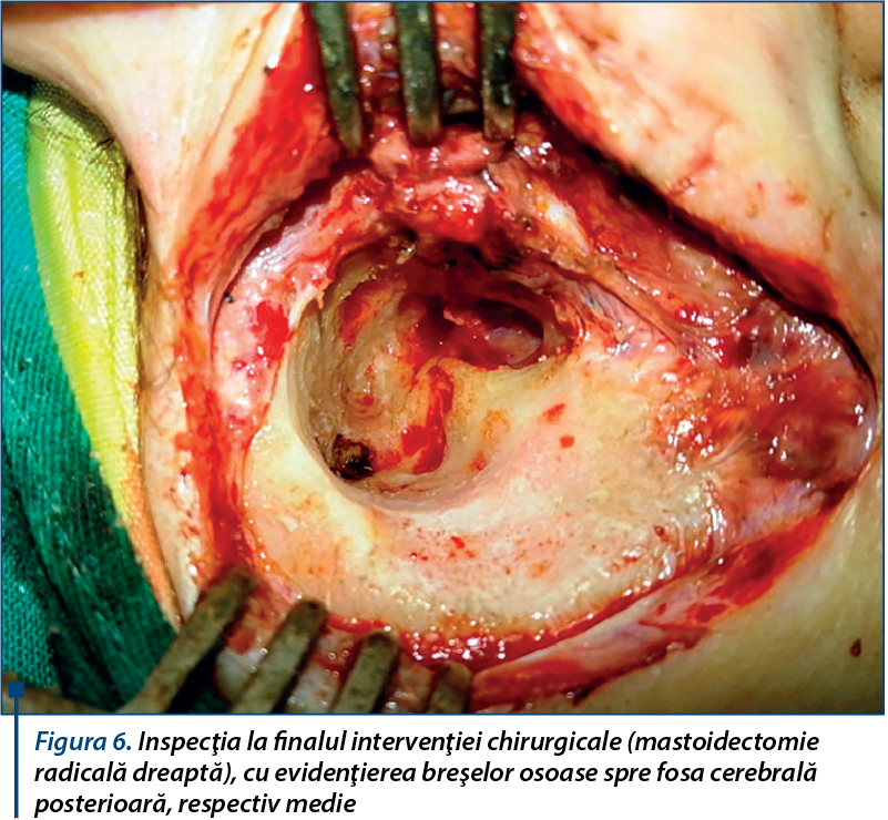 Figura 6. Inspecţia la finalul intervenţiei chirurgicale (mastoidectomie radicală dreaptă), cu evidenţierea breşelor osoase spre fosa cerebrală posterioară, respectiv medie
