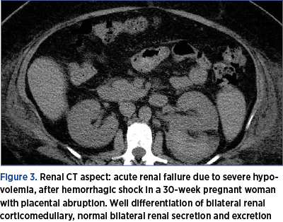 Figure 3. Renal CT aspect: acute renal failure due to severe hypovolemia, after hemorrhagic shock in a 30-week pregnant woman with placental abruption. Well differentiation of bilateral renal corticomedullary, normal bilateral renal secretion and excretion 