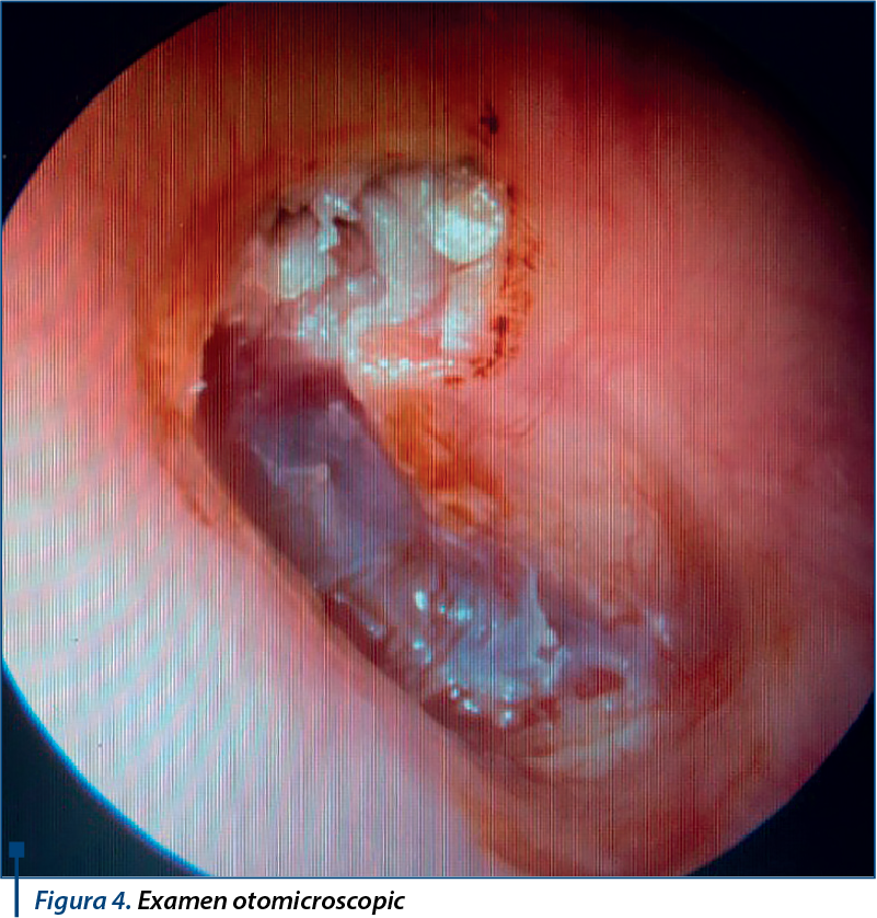 Figura 4. Examen otomicroscopic