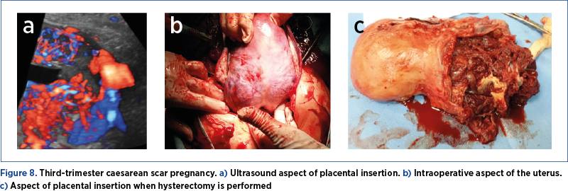 Figure 8. Third-trimester caesarean scar pregnancy. a) Ultrasound aspect of placental insertion. b) Intraoperative aspect of the uterus. c) Aspect of placental insertion when hysterectomy is performed