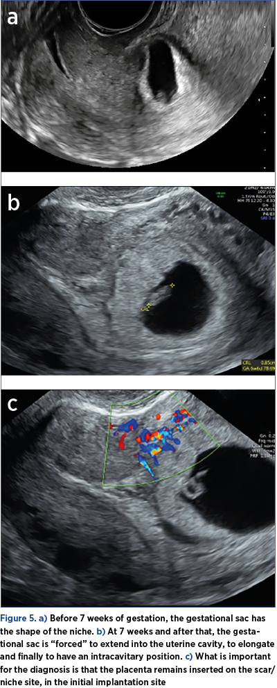 Figure 5. a) Before 7 weeks of gestation, the gestational sac has the shape of the niche. b) At 7 weeks and after that, the gestational sac is “forced” to extend into the uterine cavity, to elongate and finally to have an intracavitary position. c) What is important for the diagnosis is that the placenta remains inserted on the scar/niche site, in the initial implantation site
