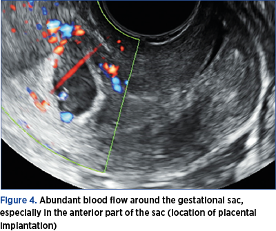 Figure 4. Abundant blood flow around the gestational sac, espe­cial­ly in the anterior part of the sac (location of placental implantation)