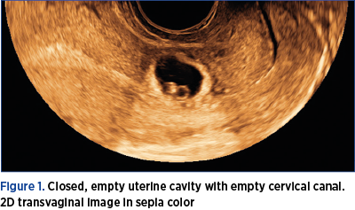 Figure 1. Closed, empty uterine cavity with empty cervical canal. 2D transvaginal image in sepia color 