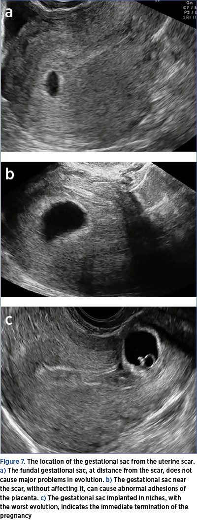 Figure 7. The location of the gestational sac from the uterine scar. a) The fundal gestational sac, at distance from the scar, does not cause major problems in evolution. b) The gestational sac near the scar, without affecting it, can cause abnormal adhesions of the placenta. c) The gestational sac implanted in niches, with the worst evolution, indicates the immediate termination of the pregnancy