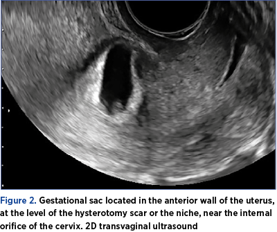 Figure 2. Gestational sac located in the anterior wall of the uterus, at the level of the hysterotomy scar or the niche, near the internal orifice of the cervix. 2D transvaginal ultrasound