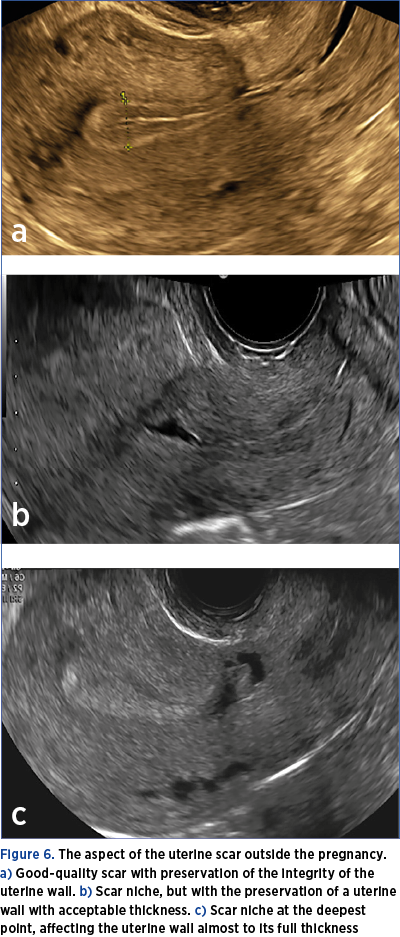 Figure 6. The aspect of the uterine scar outside the pregnancy. a) Good-quality scar with preservation of the integrity of the uterine wall. b) Scar niche, but with the preservation of a uterine wall with acceptable thickness. c) Scar niche at the deepest point, affecting the uterine wall almost to its full thickness