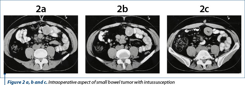 Figure 2 a, b and c. Intraoperative aspect of small bowel tumor with intussusception