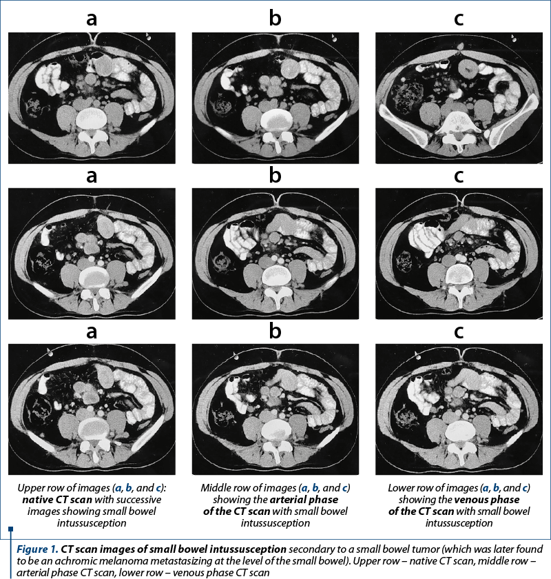 Figure 1. CT scan images of small bowel intussusception secondary to a small bowel tumor (which was later found to be an achromic melanoma metastasizing at the level of the small bowel). Upper row – native CT scan, middle row – arterial phase CT scan, lower row – venous phase CT scan