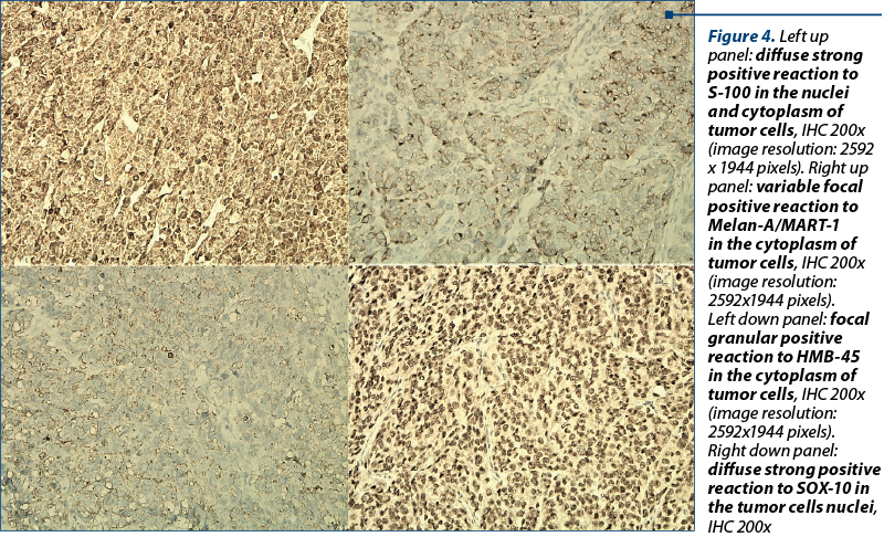Figure 4. Left up panel: diffuse strong positive reaction to S-100 in the nuclei and cytoplasm of tumor cells, IHC 200x (image resolution: 2592 x 1944 pixels). Right up panel: varia­ble focal positive reac­tion to Melan-A/MART-1 in the cyto­plasm of tumor cells, IHC 200x (image resolution: 2592x1944 pixels).  Left down panel: focal granular positive reaction to HMB-45 in the cytoplasm of tumor cells, IHC 200x (image resolution: 2592x1944 pixels).  Right down panel: diffuse strong positive reaction to SOX-10 in the tumor cells nuclei, IHC 200x