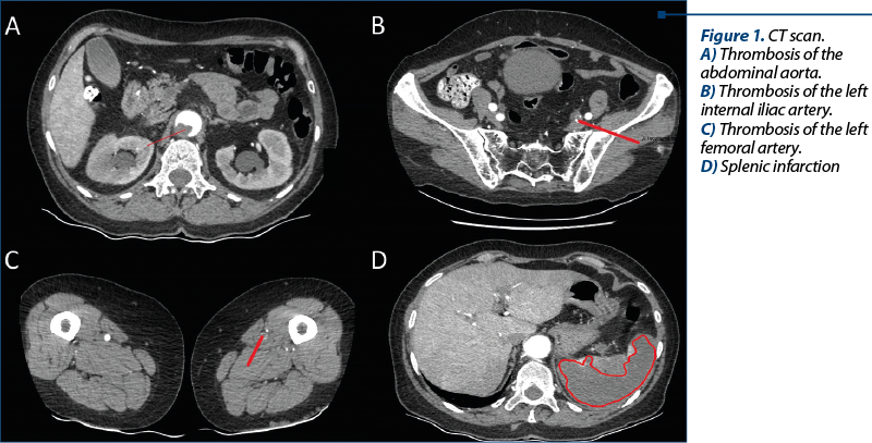 Figure 1. CT scan.  A) Thrombosis of the abdominal aorta.  B) Thrombosis of the left internal iliac artery.  C) Thrombosis of the left femoral artery.  D) Splenic infarction