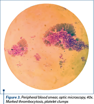 Figure 3. Peripheral blood smear, optic microscopy, 40x. Marked thrombocytosis, platelet clumps