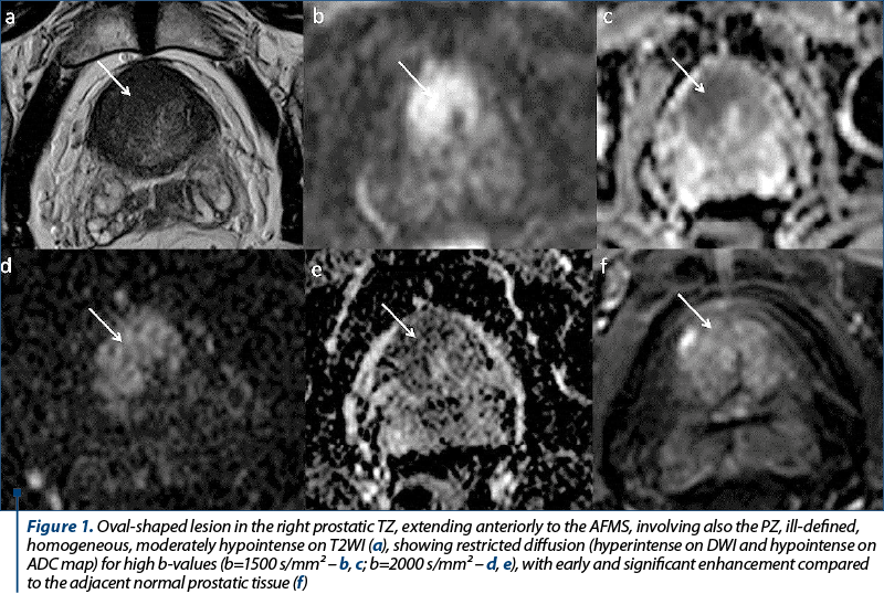 Figure 1. Oval-shaped lesion in the right pro­sta­tic TZ, extending an­te­riorly to the AFMS, in­vol­ving also the PZ, ill-defined, homogeneous, moderately hypointense on T2WI (a), showing re­stric­ted diffusion (hy­per­intense on DWI and hypointense on ADC map) for high b-values (b=1500 s/mm² – b, c; b=2000 s/mm² – d, e), with early and significant enhancement compared to the adjacent normal prostatic tissue (f)