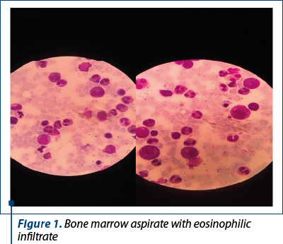 Figure 1. Bone marrow aspirate with eosinophilic infiltrate