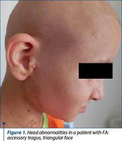 Figure 1. Head abnormalities in a patient with FA: accessory tragus, triangular face 