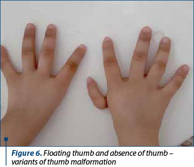 Figure 6. Floating thumb and absence of thumb – variants of thumb malformation
