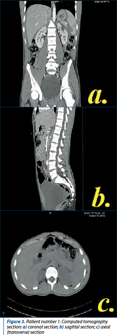 Figure 3. Patient number 1. Computed tomography section: a) coronal section; b) sagittal section; c) axial (transverse) section