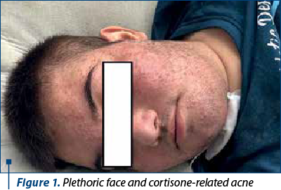 Figure 1. Plethoric face and cortisone-related acne