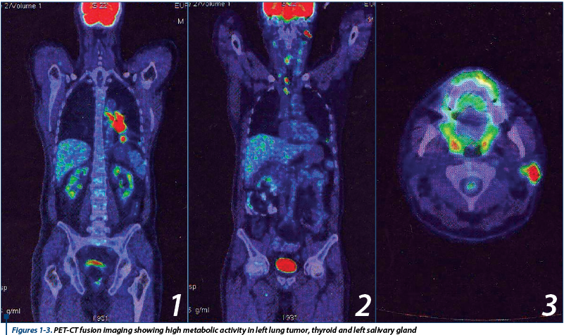 Figures 1-3. PET-CT fusion imaging showing high metabolic activity in left lung tumor, thyroid and l