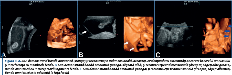 Figura 3. A. SBA demonstrând bandă amniotică (stânga) şi reconstrucţie tridimensională (dreapta), evidenţiind trei extremităţi ancorate la nivelul amniosului şi interferenţa cu membrele fetale. B. SBA demonstrând bandă amniotică (stânga, săgeată albă) şi reconstrucţie tridimensională (dreapta, săgeţi albe groase). Banda amniotică nu interceptează segmente fetale. C. SBA demonstrând bandă amniotică (stânga) şi reconstrucţie tridimensională (dreapta, săgeţi albastre). Banda amniotică este aderentă la faţa fetală