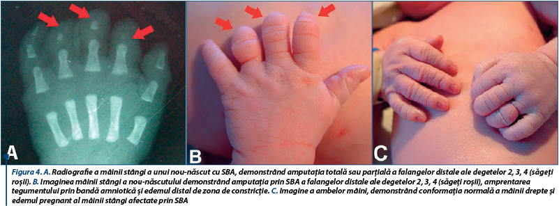 Figura 4. A. Radiografie a mâinii stângi a unui nou-născut cu SBA, demonstrând amputaţia totală sau parţială a falangelor distale ale degetelor 2, 3, 4 (săgeţi roşii). B. Imaginea mâinii stângi a nou-născutului demonstrând amputaţia prin SBA a falangelor distale ale degetelor 2, 3, 4 (săgeţi roşii), amprentarea tegumentului prin bandă amniotică şi edemul distal de zona de constricţie. C. Imagine a ambelor mâini, demonstrând conformaţia normală a mâinii drepte şi edemul pregnant al mâinii stângi afectate prin SBA