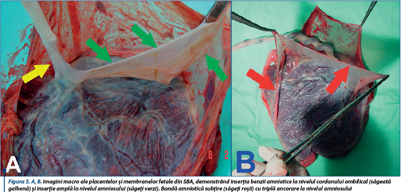 Figura 5. A, B. Imagini macro ale placentelor şi membranelor fetale din SBA, demonstrând inserţia benzii amniotice la nivelul cordonului ombilical (săgeată galbenă) şi inserţie amplă la nivelul amniosului (săgeţi verzi). Bandă amniotică subţire (săgeţi roşii) cu triplă ancorare la nivelul amniosului