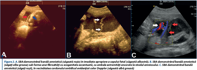 Figura 2. A. SBA demonstrând bandă amniotică (săgeată roşie) în imediata apropiere a capului fetal (săgeată albastră). B. SBA demonstrând bandă amniotică (săgeţi albe groase) sub forma unei fibrozităţi cu ecogenitate accentuată, cu ambele extremităţi ancorate la nivelul amniosului. C. SBA demonstrând bandă amniotică (săgeţi roşii), în vecinătatea cordonului ombilical evidenţiat color Doppler (săgeată albă groasă)