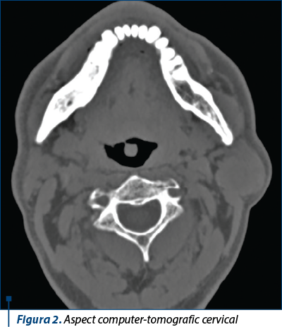 Figura 2. Aspect computer-tomografic cervical