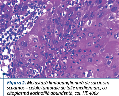 Figura 2. Metastază limfoganglionară de carcinom scuamos – celule tumorale de talie medie/mare, cu citoplasmă eozinofilă abundentă, col. HE 400x
