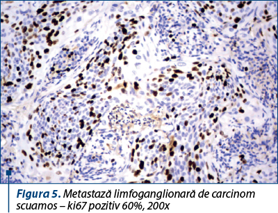 Figura 5. Metastază limfoganglionară de carcinom scuamos – ki67 pozitiv 60%, 200x