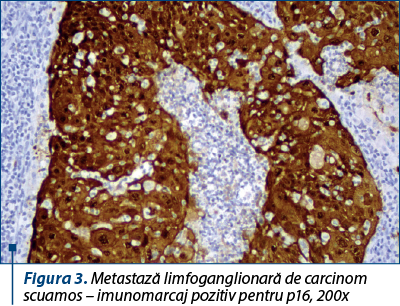 Figura 3. Metastază limfoganglionară de carcinom scuamos – imunomarcaj pozitiv pentru p16, 200x