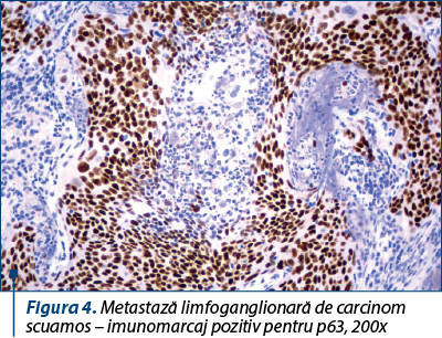 Figura 4. Metastază limfoganglionară de carcinom scuamos – imunomarcaj pozitiv pentru p63, 200x