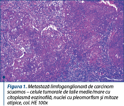 Figura 1. Metastază limfoganglionară de carcinom scua­­mos – celule tumorale de talie medie/mare cu ci­to­plas­mă eozinofilă, nuclei cu pleomorfism şi mitoze ati­pi­ce, col. HE 100x