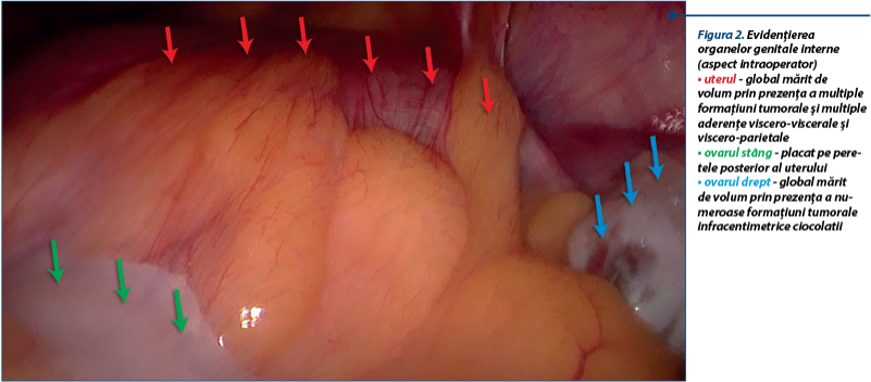 Figura 2. Evidenţierea  organelor genitale interne (aspect intraoperator) • uterul - global mărit de volum prin prezenţa a multiple formaţiuni tumorale şi multiple aderenţe viscero-viscerale şi viscero-parietale • ovarul stâng - placat pe peretele posterior al uterului • ovarul drept - global mărit de volum prin prezenţa a numeroase formaţiuni tumorale infracentimetrice ciocolatii