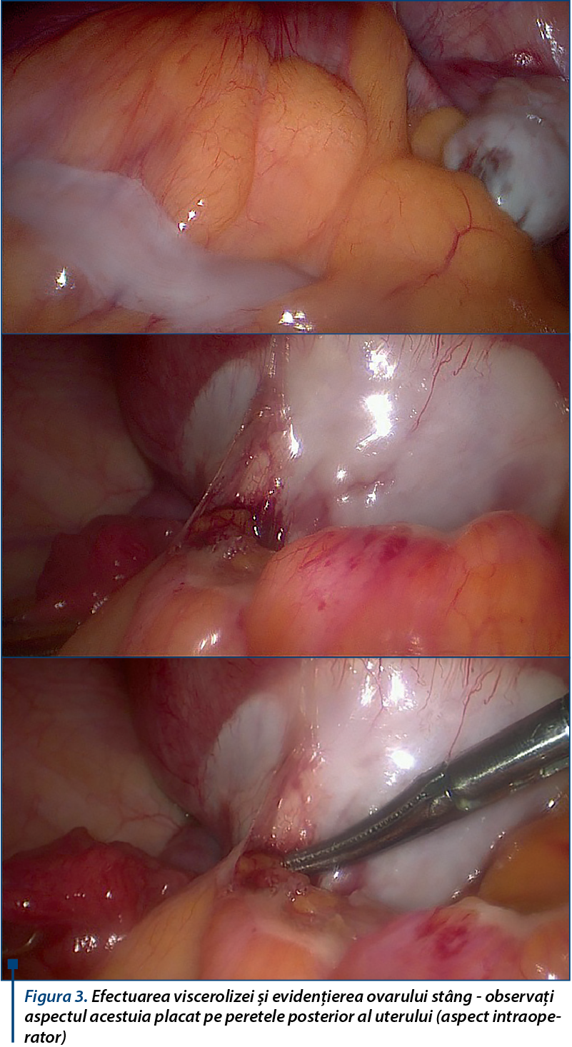 Figura 3. Efectuarea viscerolizei şi evidenţierea ovarului stâng - observaţi aspectul acestuia placat pe peretele posterior al uterului (aspect intraoperator)