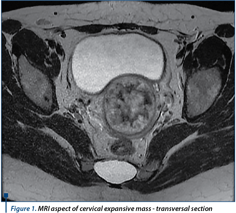 Figure 1. MRI aspect of cervical expansive mass - transversal section