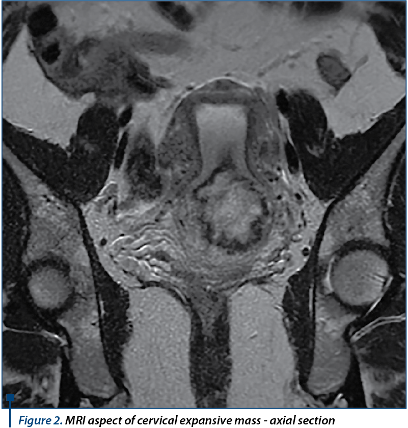 Figure 2. MRI aspect of cervical expansive mass - axial section