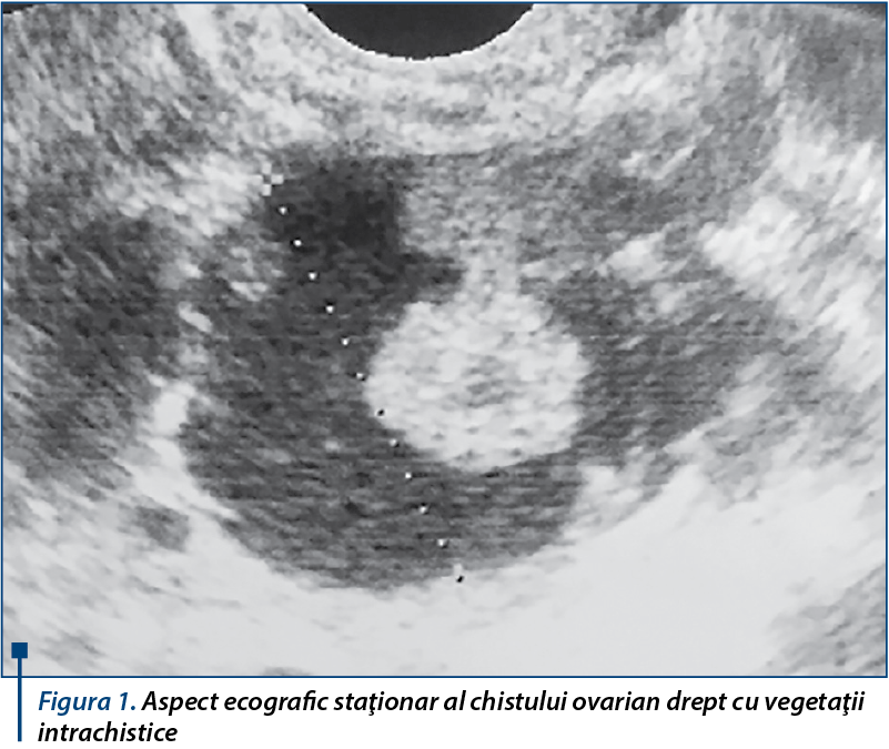 Figura 1. Aspect ecografic staţionar al chistului ovarian drept cu vegetaţii intrachistice