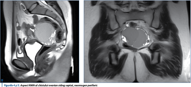 Figurile 4 şi 5. Aspect RMN al chistului ovarian stâng septat, neomogen periferic