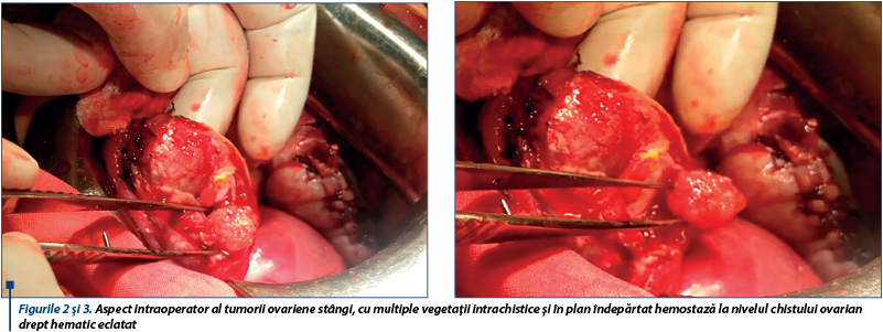Figurile 2 şi 3. Aspect intraoperator al tumorii ovariene stângi, cu multiple vegetaţii intrachistice şi în plan îndepărtat hemostază la nivelul chistului ovarian drept hematic eclatat