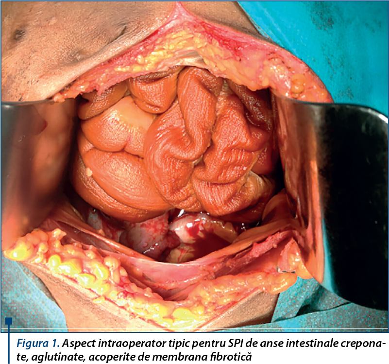 Figura 1. Aspect intraoperator tipic pentru SPI de anse intestinale creponate, aglutinate, acoperite de membrana fibrotică
