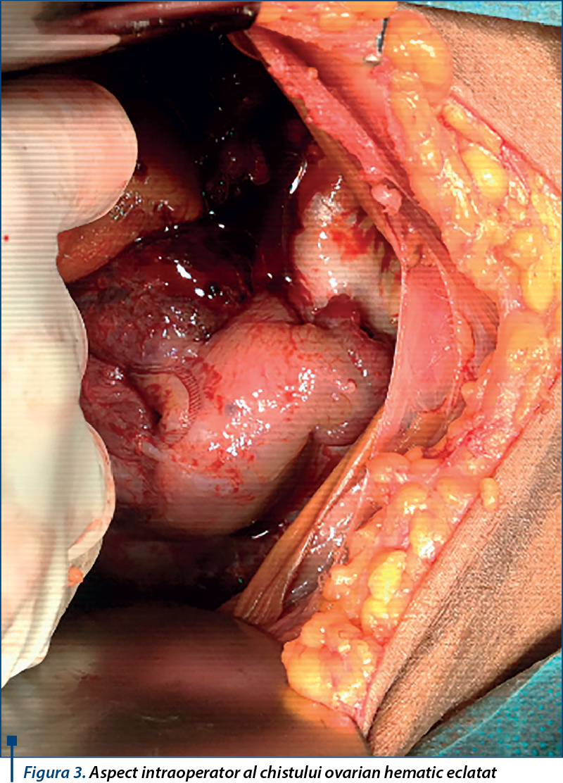 Figura 3. Aspect intraoperator al chistului ovarian hematic eclatat