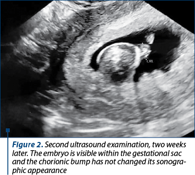 Figure 2. Second ultrasound examination, two weeks later. The embryo is visible within the gestational sac and the chorionic bump has not changed its so­no­gra­phic appearance