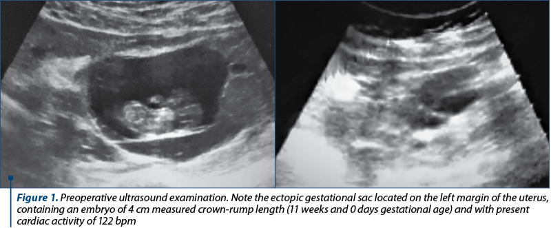 Figure 1. Preoperative ultrasound examination. Note the ectopic gestational sac located on the left margin of the uterus, containing an embryo of 4 cm measured crown-rump length (11 weeks and 0 days gestational age) and with present cardiac activity of 122 bpm