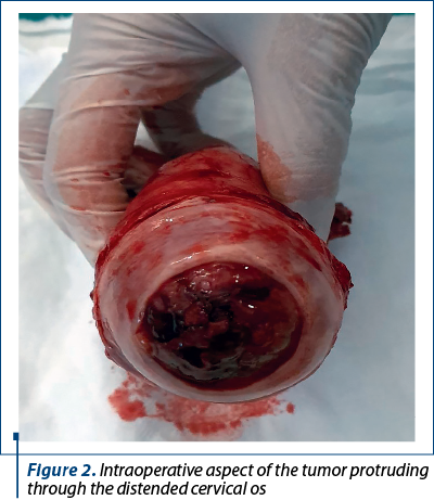 Figure 2. Intraoperative aspect of the tumor protruding through the distended cervical os