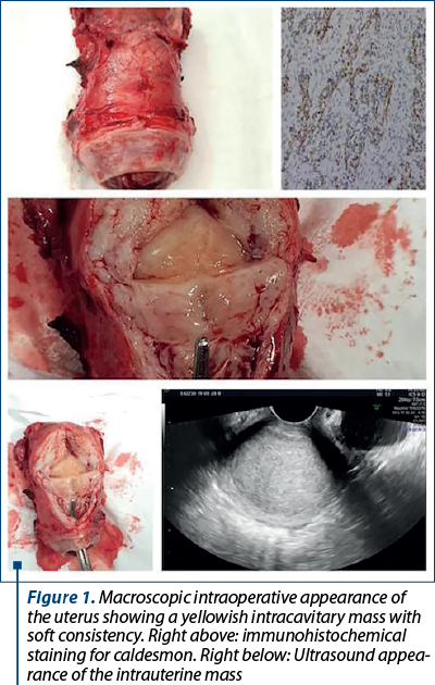 Figure 1. Macroscopic intra­operative appea­rance of the uterus showing a yellowish intracavitary mass with soft consistency. Right above: im­mu­no­his­to­che­mi­cal staining for caldesmon. Right below: Ultrasound ap­pea­rance of the intrauterine mass