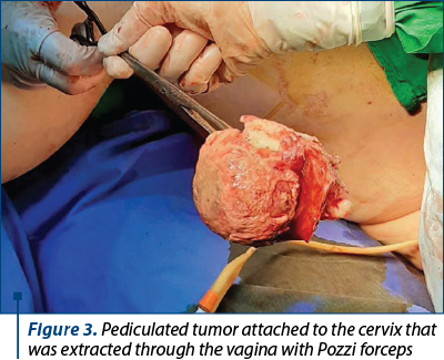 Figure 3. Pediculated tumor attached to the cervix that was extracted through the vagina with Pozzi forceps