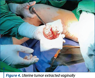 Figure 4. Uterine tumor extracted vaginally