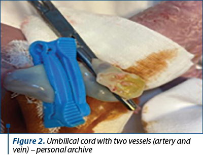 Figure 2. Umbilical cord with two vessels (artery and vein) – personal archive