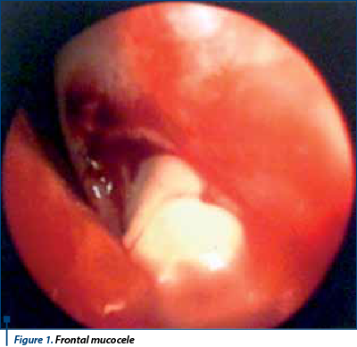 Figure 1. Frontal mucocele